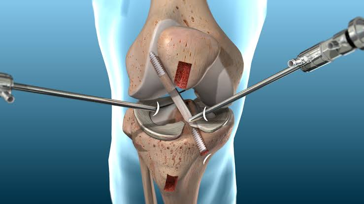 ACL Reconstruction