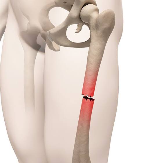 Complex Fracture and Trauma Management