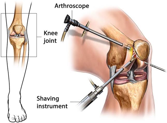 Knee Arthroscopy