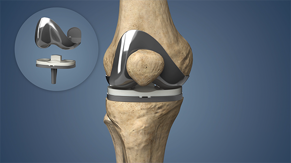 Knee Joint Replacement