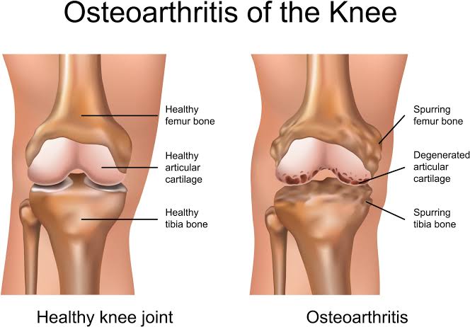 Osteo Arthritic Joint Care