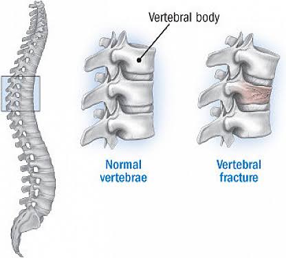 Osteoporotic Fracture Treatment