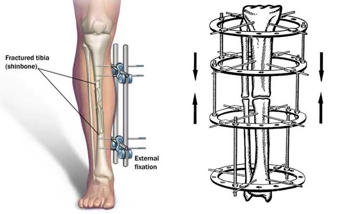 Ilizarov and Limb Reconstructions